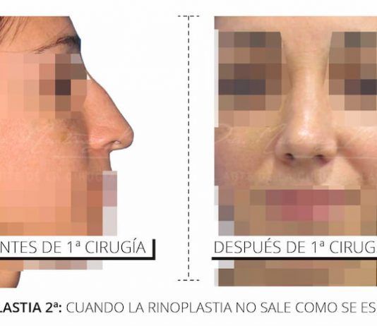 Rinoplastia secundaria Cuando la rinoplastia No Sale como esperabas
